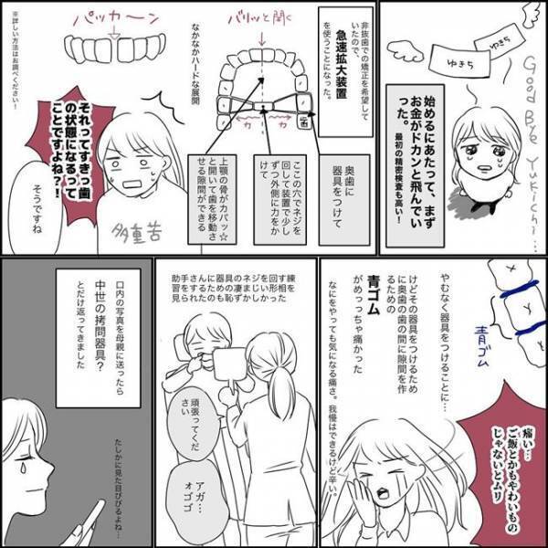 ＜歯列矯正で笑えるように＞「中世の拷問器具ですか…？」口に装着したあるものにびっくり！