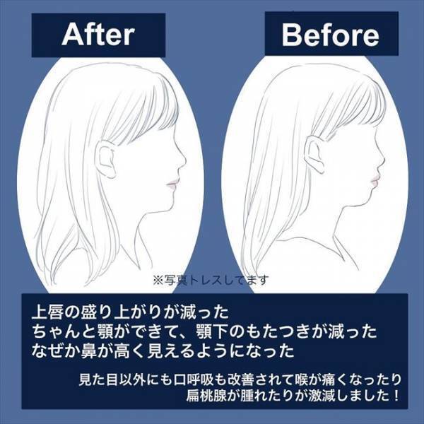 ＜歯列矯正をして笑えるように＞「鼻が高く…」矯正をした結果、見た目に驚きの変化が！？