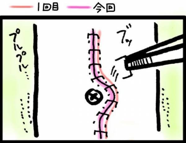 ＜40代で子宮がん＞「投薬をやめましょう」治ってないのに！？さらに腸閉塞の原因を聞くと？