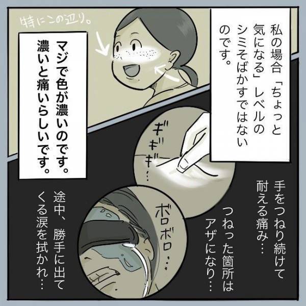 ＜シミ取りレーザー＞「あてますよ〜…バチンッ」痛ぁっ！レーザー施術開始。この痛みはまさに？！