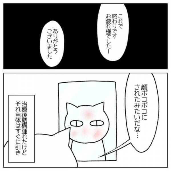 ＜顔のシミ取り＞「バチッバチッ」ん？麻酔効いてる？レーザーを当てられた瞬間ヒヤリとして