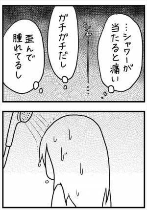 ＜PMSが乳腺炎＞「歪んで腫れてる」膿でガチガチ。シャワーで激痛。苦痛はいつまで？