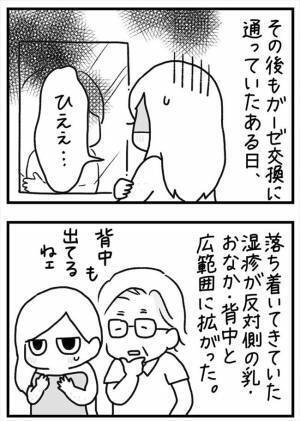 ＜PMSが乳腺炎＞「ひええ…」全身に湿疹！その原因はまさかの？！