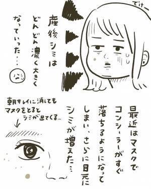 【経過写真あり】「消すのダルい」産後にシミ激増。レーザー治療6日後に驚きの変化が！