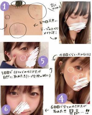 【経過写真あり】「消すのダルい」産後にシミ激増。レーザー治療6日後に驚きの変化が！