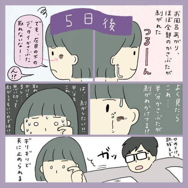 ＜アラフォーシミ取り＞「うわ！エグッ」術後の赤みとヒリヒリに不安。ダウンタイムの経過は？！