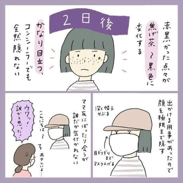 ＜アラフォーシミ取り＞「うわ！エグッ」術後の赤みとヒリヒリに不安。ダウンタイムの経過は？！