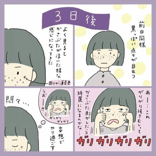 ＜アラフォーシミ取り＞「うわ！エグッ」術後の赤みとヒリヒリに不安。ダウンタイムの経過は？！