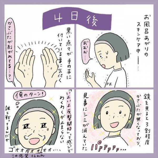 ＜アラフォーシミ取り＞「うわ！エグッ」術後の赤みとヒリヒリに不安。ダウンタイムの経過は？！