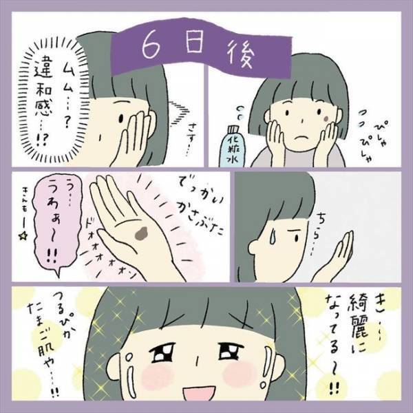 ＜アラフォーシミ取り＞「うわ！エグッ」術後の赤みとヒリヒリに不安。ダウンタイムの経過は？！