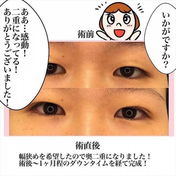 ＜喪女が二重整形＞「グッと開けて」うわぁ入ってくる！まぶたの裏に見えた影の正体は！？