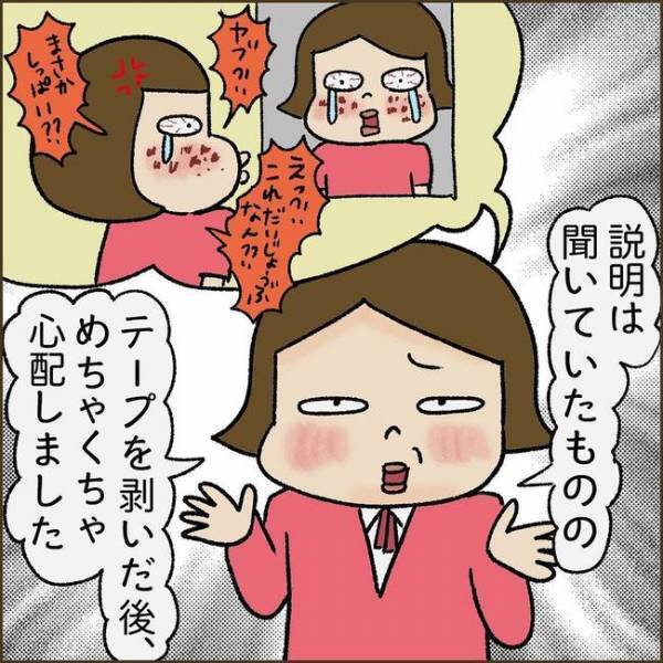 ＜51歳シミ取り初挑戦＞「まさか失敗？」シミ取り後、鏡を見て驚愕。赤黒い跡になっていて！？