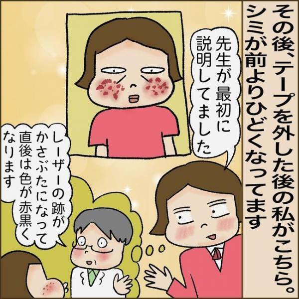 ＜51歳シミ取り初挑戦＞「まさか失敗？」シミ取り後、鏡を見て驚愕。赤黒い跡になっていて！？