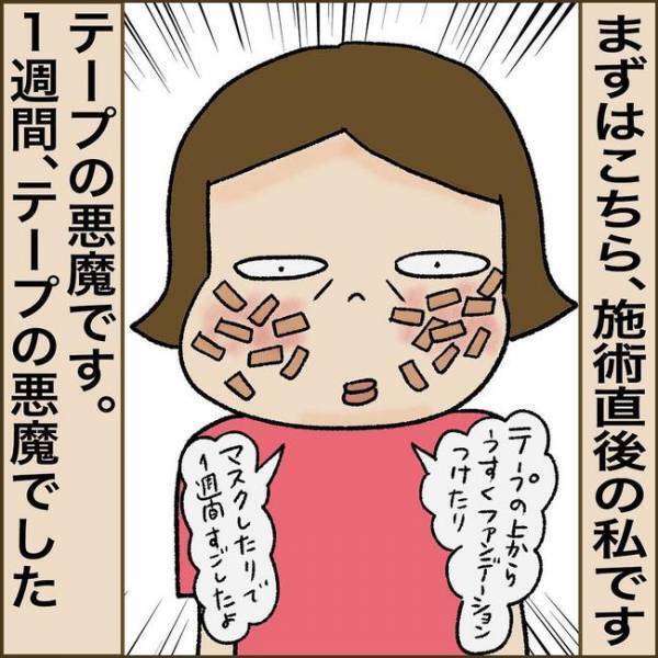 ＜51歳シミ取り初挑戦＞「まさか失敗？」シミ取り後、鏡を見て驚愕。赤黒い跡になっていて！？