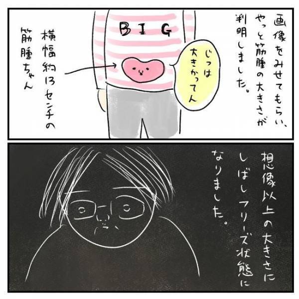 「臓器は大丈夫でしょうか？」医師に聞くと衝撃の答えが＜巨大筋腫＞