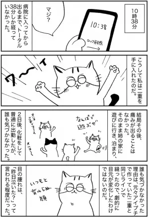 「5万で悩み解消！」面倒なアイプチからの卒業。埋没法で得たものは？＜埋没レポ 後編＞