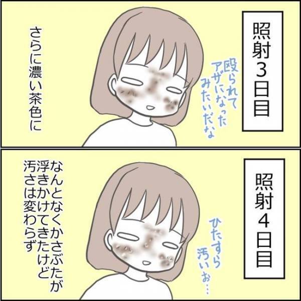 「本当に大丈夫？」顔面を見て夫がドン引き。シミ取り後の顔を心配されて！？＜ママがシミ取り＞