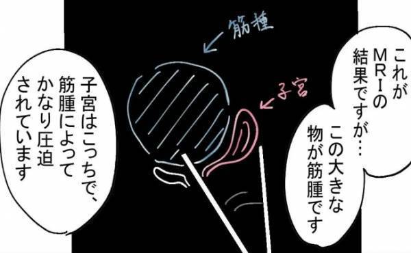 「巨大な筋腫のせいで…」MRI検査でわかった驚くべき事実とは？＜不妊の原因は？＞