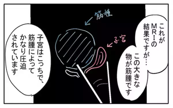 「巨大な筋腫のせいで…」MRI検査でわかった驚くべき事実とは？＜不妊の原因は？＞