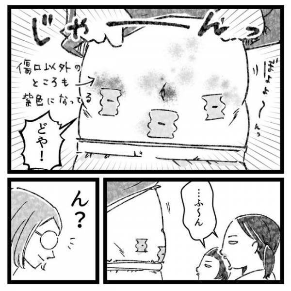 「ギャアアア！！」お風呂に入ろうとすると夫が大絶叫！？そのワケとは？＜おなかの爆弾とりました＞