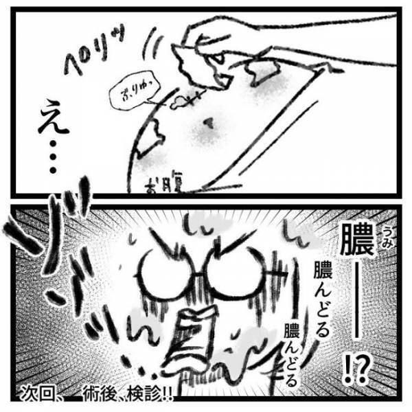 「ぶりゅっ」→ギャーッ！おなかの傷口から出てきたものとは！？＜おなかの爆弾とりました＞