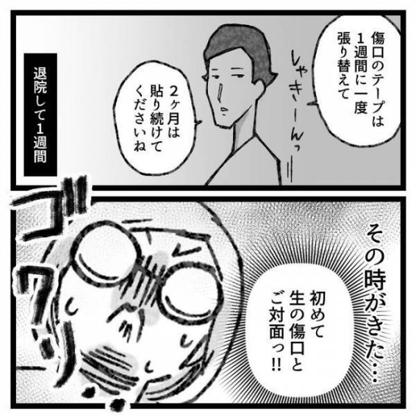 「ぶりゅっ」→ギャーッ！おなかの傷口から出てきたものとは！？＜おなかの爆弾とりました＞
