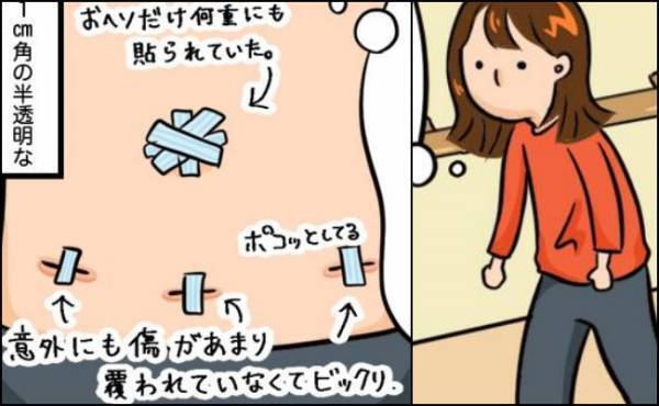 「傷はどんな感じ？」術後のおなかの様子を初めて目にするときが！＜卵巣嚢腫手術＞