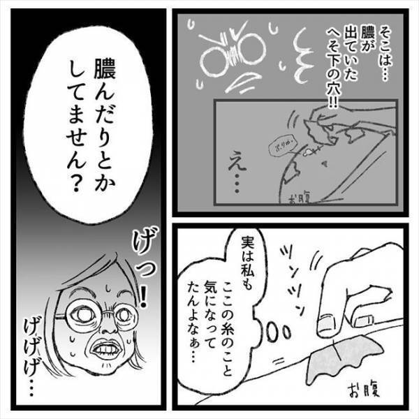 「…あれっ？」まじまじとへそを見つめられ…医師からまさかのひと言！＜おなかの爆弾とりました＞