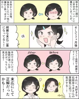 「半永久だから安心」埋没法時代に恐れていたあの悩みから解放！＜二重切開レポ＞