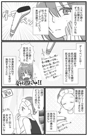 なんとかしたい！毛穴の開き＆ニキビ跡⇒ある方法を試した結果…？！【ダーマペン体験マンガ】