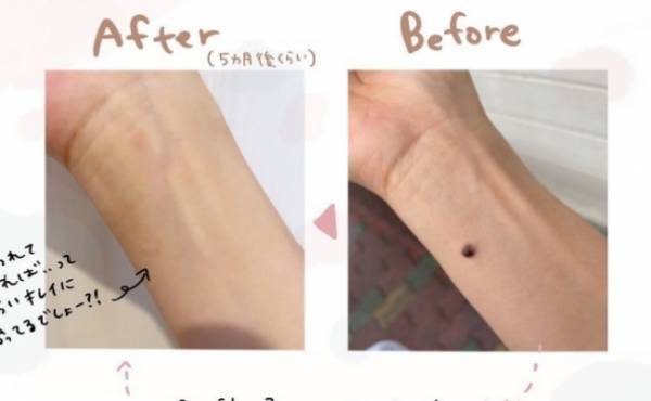 「汁が出てる…！？」患部の状態を医師に見せるとあるアドバイスをされて＜ほくろ除去レポ＞
