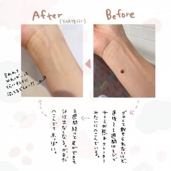 「汁が出てる…！？」患部の状態を医師に見せるとあるアドバイスをされて＜ほくろ除去レポ＞