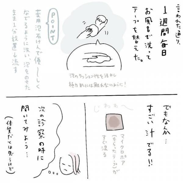 「汁が出てる…！？」患部の状態を医師に見せるとあるアドバイスをされて＜ほくろ除去レポ＞