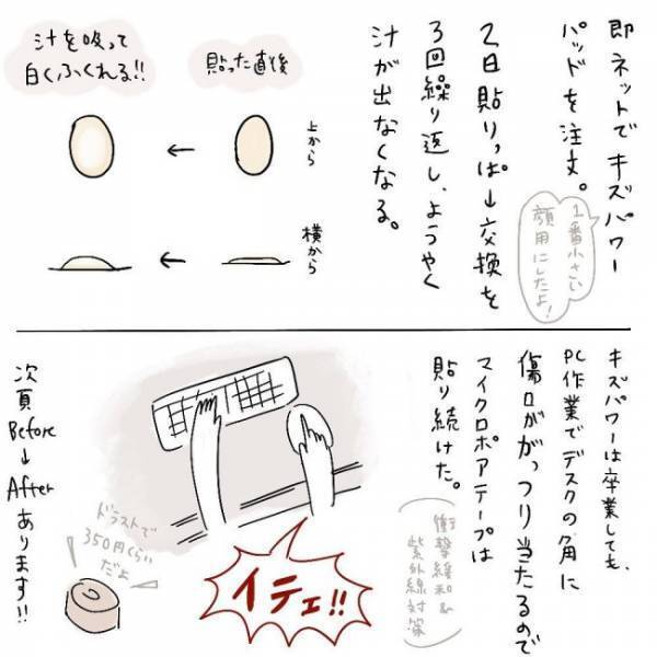 「汁が出てる…！？」患部の状態を医師に見せるとあるアドバイスをされて＜ほくろ除去レポ＞