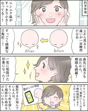 「顔がパンパン」ダウンタイムを乗り越え半年後⇒ニンニク鼻はどうなった？＜耳介軟骨移植レポ ＞