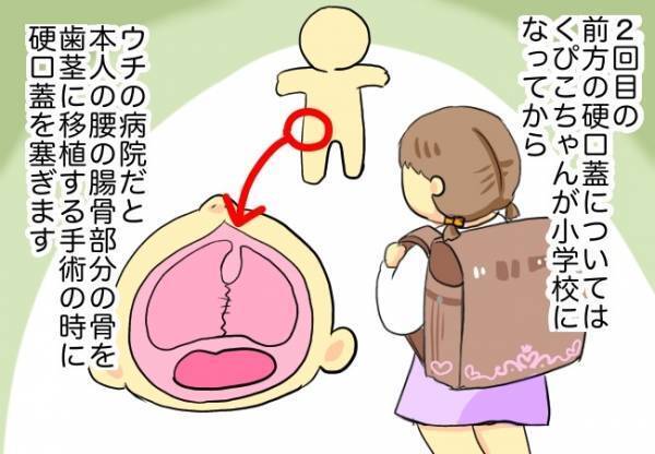 衝撃！え…2回も手術するの！？【口唇口蓋裂ちゃん、育ててます】
