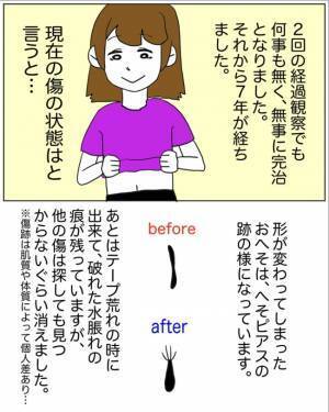「卵巣が半分になりました」医師の言葉にショックもあり安堵な気持ちもあり＜半分になった卵巣＞