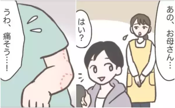 「また歯形が…」保育園で3カ月続いた噛みつきトラブル⇒先生に相談した結果、園がとった対応とは