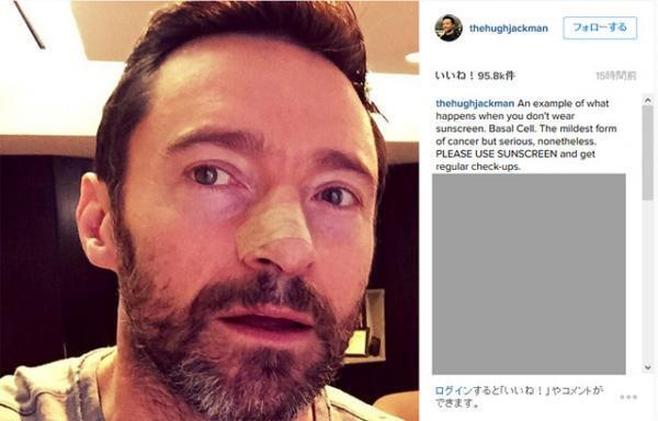 ヒュー・ジャックマン、鼻の皮膚がんが再発し5度目の手術をファンに報告