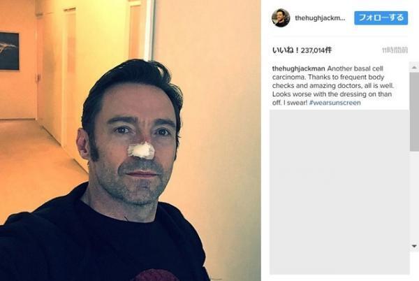 ヒュー・ジャックマン、鼻の皮膚がんをまた除去手術！