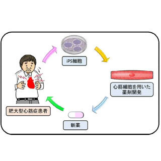 慶應大、iPS細胞用いて心筋症の悪化因子を同定 - 治療法の確立へ前進