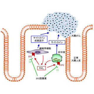 京大、炎症性大腸がんの形成に寄与する受容体を同定