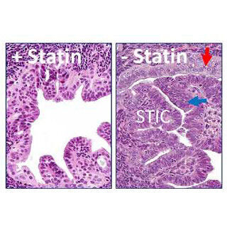 脂質異常症の治療薬「スタチン」が卵巣がんを抑制 - 慶大がマウスで確認
