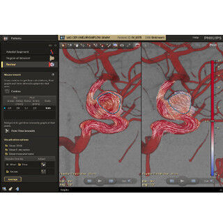 フィリップス、脳動脈血流のリアルタイム画像解析を実現するシステムを発売