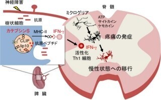 九大、「神経障害性疼痛」の慢性化の仕組みの一部を解明
