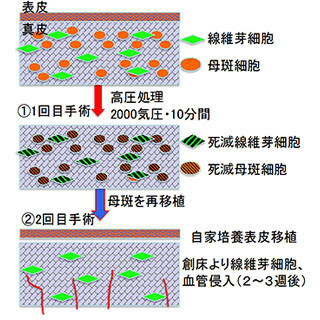 切除した"巨大なほくろ"自体を用いて皮膚を再建する治療法 - 関西医大など