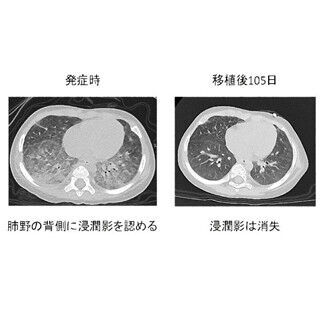 TMDU、肺の希少疾患に対し造血細胞移植による治療に成功