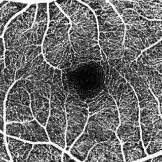 キヤノン、網膜の血管形態を描出する画像処理技術が眼科機器で利用可能に