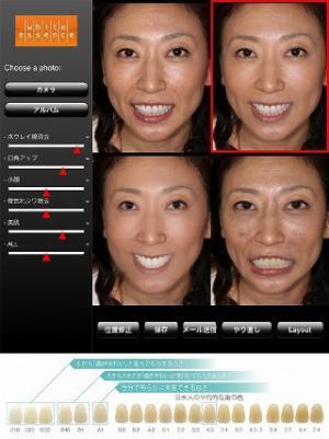 3～5年後の美しい歯と笑顔をシミュレート!　デンタルエステ「Smile-Up」