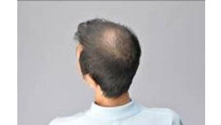 アデランス、気になる薄毛を瞬時にカバーできるヘアパウダーを発売